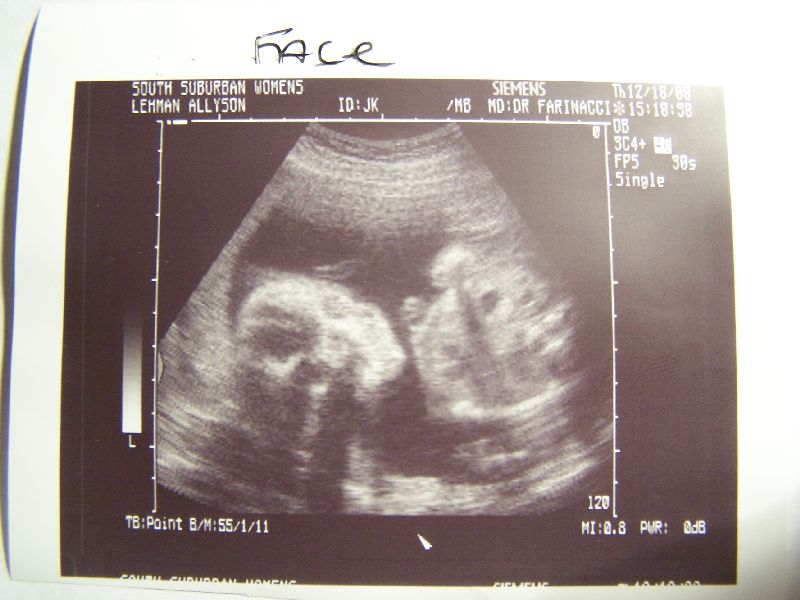 fetus at 12 weeks. Fetus+at+12+weeks+pregnant